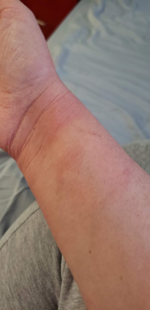 Arm with bruises from carrying heavy bags